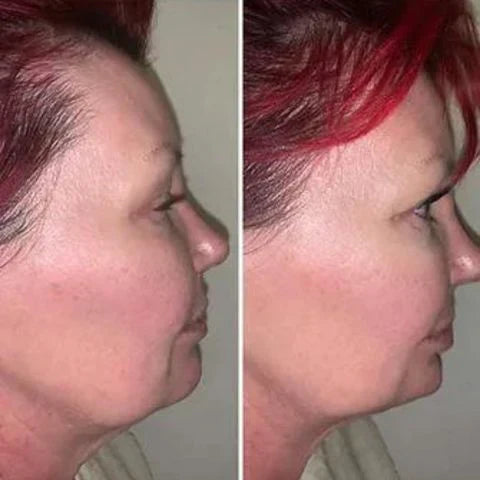 Masajeador Reductor y Rejuvenecedor Facial - SkinTone Pro