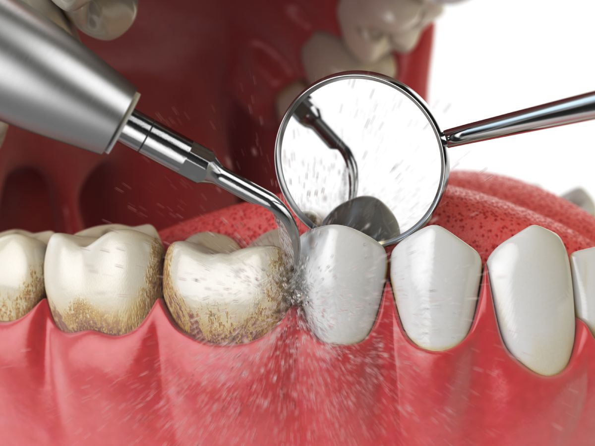 Limpiador Eléctrico Dental Ultrasónico